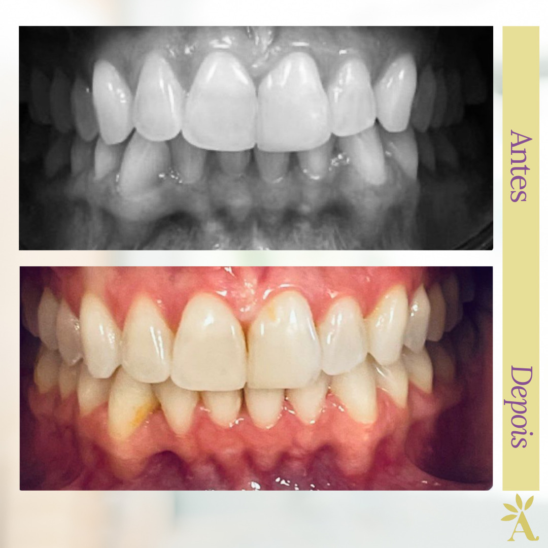 Alinhamento e Nivelamento (antes e depois)